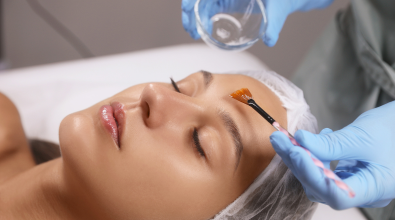 Chemical Peel